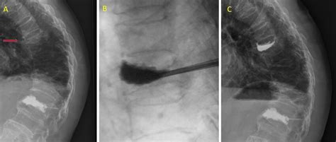 A case of T8 vertebral compression fracture treated with high-viscosity... | Download Scientific ...