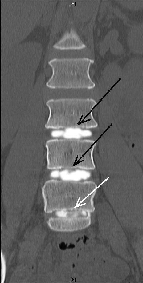 Lumbar Discograms | Lower Back Pain Diagnosis