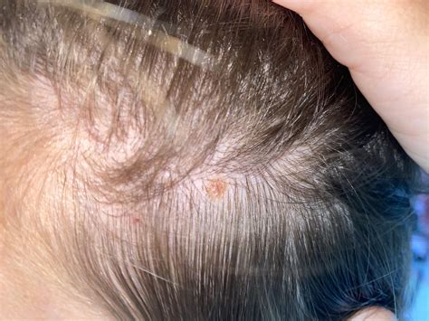 Mole on scalp. 22F : r/Melanoma