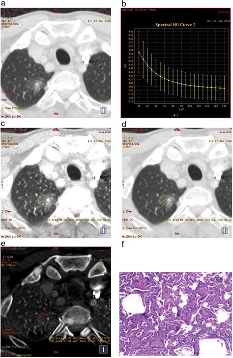 A mixed ground glass nodule in (a) the right upper lobe, (b) the... | Download Scientific Diagram