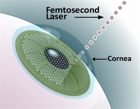 Laser Femtosecond Surgery Procedure for Overcoming Cataract - Bra Size Measurements