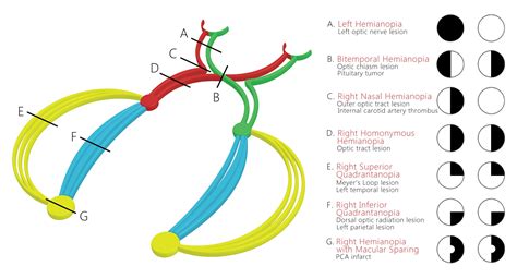 temporal parietal optic radiation - Google zoeken