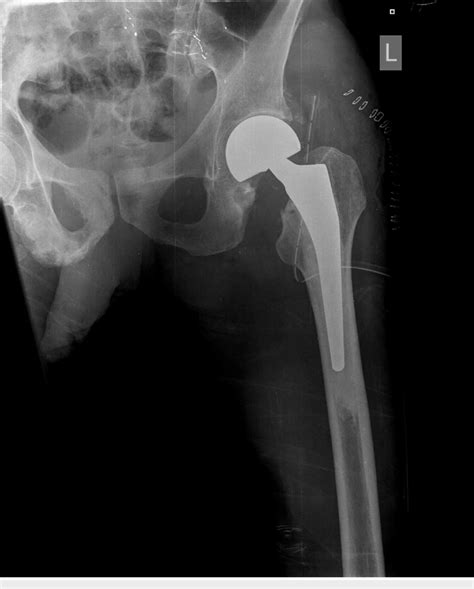 Postoperative anteroposterior radiograph of the left hip showing the ...