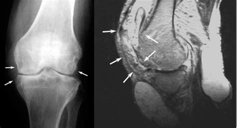 Tuberculosis of Knee Joint - Diagnosis and Treatment | Bone and Spine