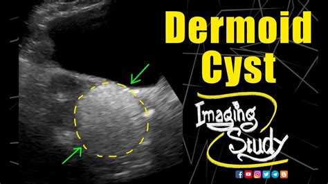 Dermoid Cyst || Ultrasound || Case 164 - YouTube