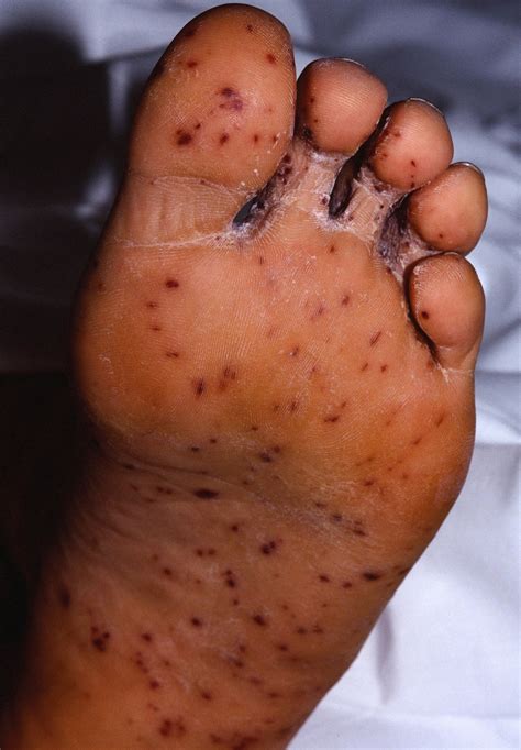 Measles - Causes, Rash, Symptoms, Signs, Measles Treatment