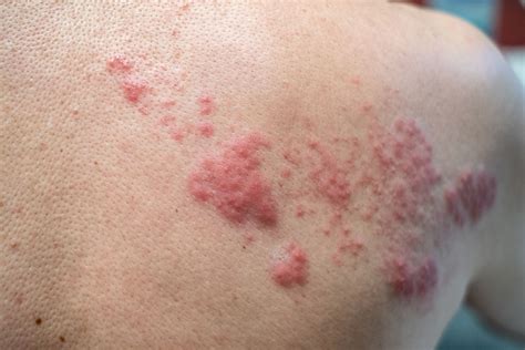 Shingles Treatment | Physicians Immediate Care