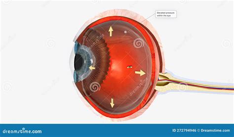 Glaucoma Human Eye Disease Cartoon Vector | CartoonDealer.com #276072623