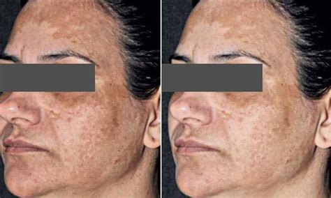 Melasma, Hyperpigmentation, Brown Spots. What is the difference? What is the best treatment ...