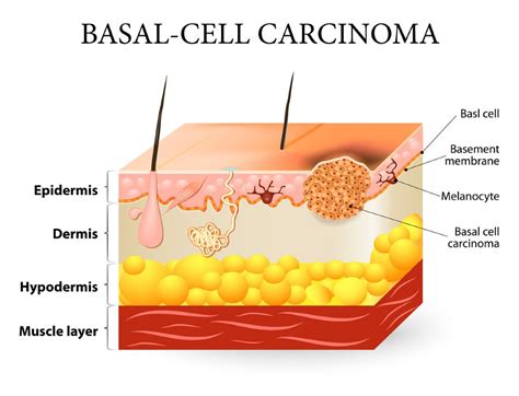 Basal Cell Carcinoma : Dr Jamie Ryan