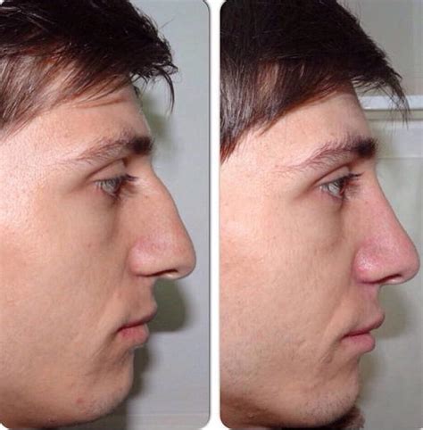 before and after nose contouring (1) » Rhinoplasty: Cost, Pics, Reviews, Q&A