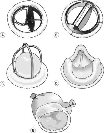 Prosthetic heart valves | Clinical Gate