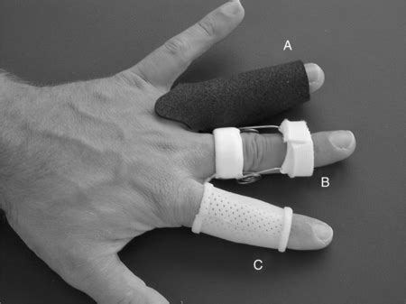 Boutonniere Deformity Swan Neck Deformity Splint - cloudshareinfo