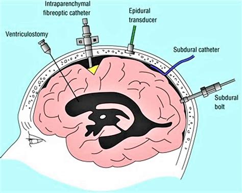 Intracranial pressure, high intracranial pressure causes, symptoms ...