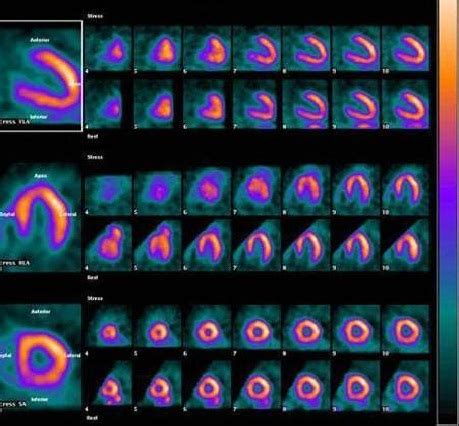 Nuclear Cardiology » Division of Cardiac Imaging » College of Medicine ...