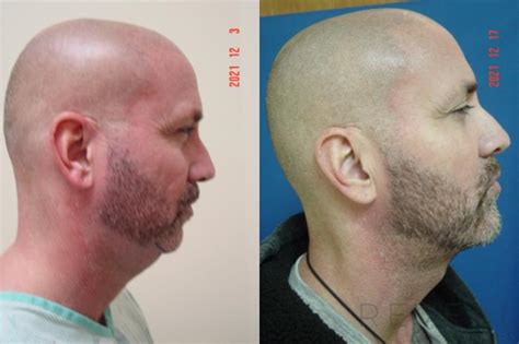 Chin Augmentation Before and After Photo Gallery | San Jose, CA ...