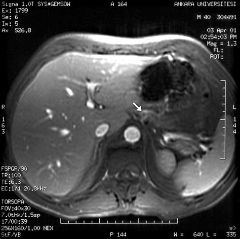 A surprising diagnosis of pancreatitis with pseudocyst associated with sudden massive effusion