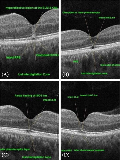 OCT images of the fovea in 1 year follow up, a shows the fovea after 1 ...