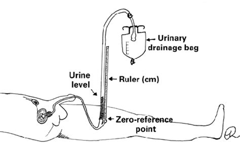 Intra-abdominal pressure measurement using the U-tube technique | Download Scientific Diagram