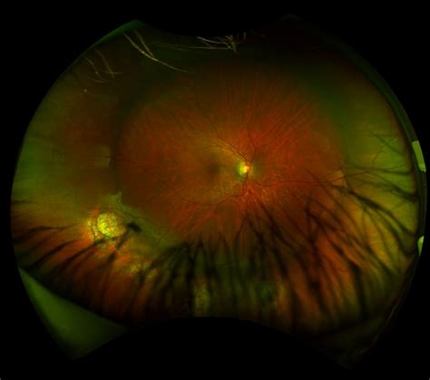 Scleral Buckle - Retina Image Bank