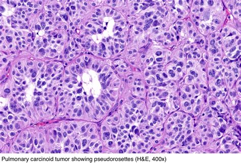 Pathology Outlines - Typical carcinoid tumor / neuroendocrine tumor, grade 1