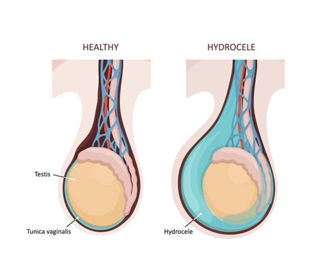 Hydrocele: Causes, Symptoms and Treatment |Advocate Health Care