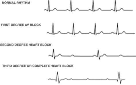 First Second And Third Degree Heart Block