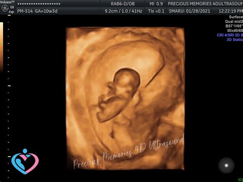 Pregnancy Ultrasound Image Gallery - 10 - 16 Weeks