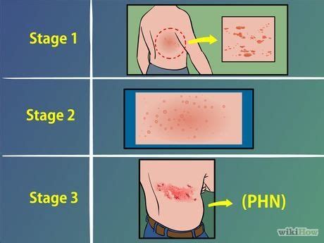 What Does Shingles Look Like On A Black Person - What Does