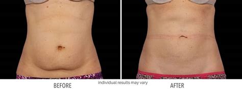 Coolsculpting Before & After Photos | Fat Freezing Technology