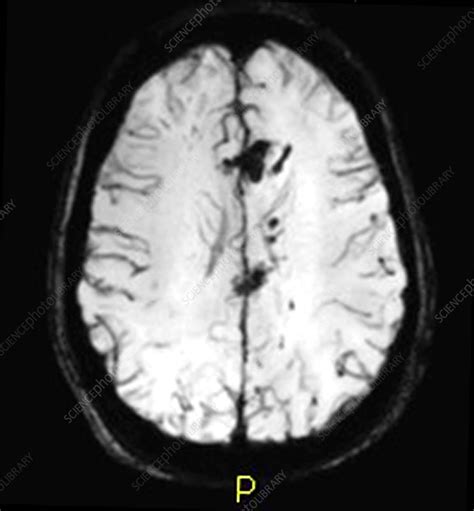 Severe Traumatic Brain Injury, MRI - Stock Image - C027/1731 - Science Photo Library