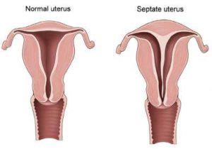 Uterine Septum - Manhattan Women's Health and Wellness Gynecology