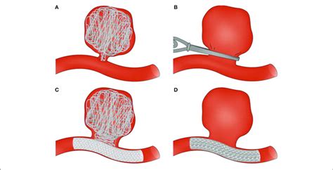 | Surgical and endovascular treatments for cerebral aneurysm... | Download Scientific Diagram