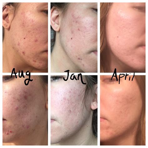 [B&A] After fifteen years of acne struggles, a derm finally recommended ...