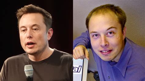 Elon Musk’s Incredible Hair Transplant - Modena Hair Institute