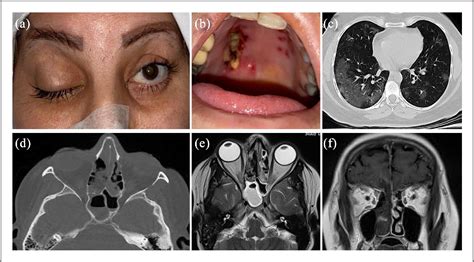 Figure 1 from Rhino-orbital mucormycosis during steroid therapy in COVID-19 patients: A case ...