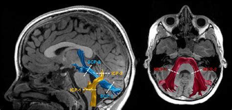 Tractography of the cerebellar peduncles. Tract renderings of the... | Download Scientific Diagram