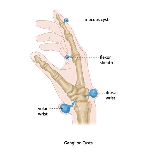 Ganglion Cyst Diagram