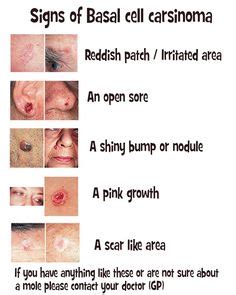 Medical | Tuberous sclerosis, Medical, Neuroscience