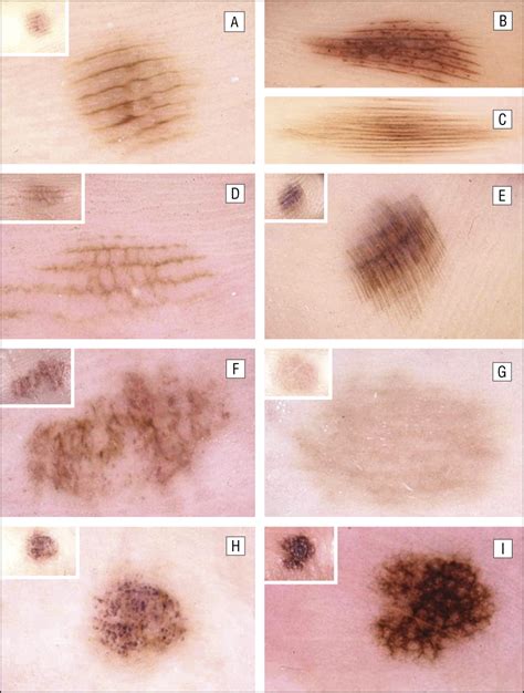 Dermoscopic Patterns of Acral Melanocytic Nevi and Melanomas in a White Population in Central ...