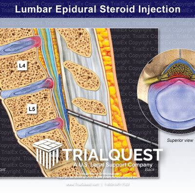 Lumbar Epidural Steroid Injection - TrialExhibits Inc.