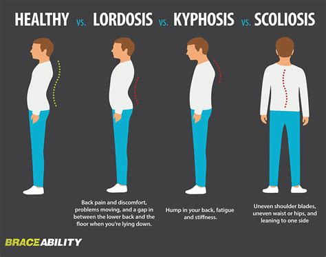 scoliosis and kyphosis – Six0wllts