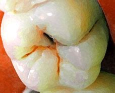 Dental Caries - treatment of Dental Caries , types Diseases, Index A –Z, medicines, Dental ...