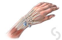 Wrist Ganglion | dr Sonja Cerovac