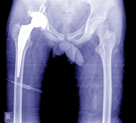 Premium Photo | Total hip arthroplasty, x-ray image very good quality show post operation at hip.