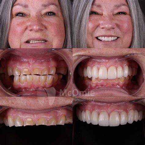 Options for Full Mouth Reconstruction - McOmie Dentistry Chattanooga