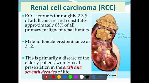 Renal cell carcinoma ( RCC ; Aetiology , Histopathology , spread) - YouTube