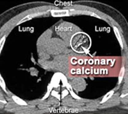 Calcium Heart Score By Age