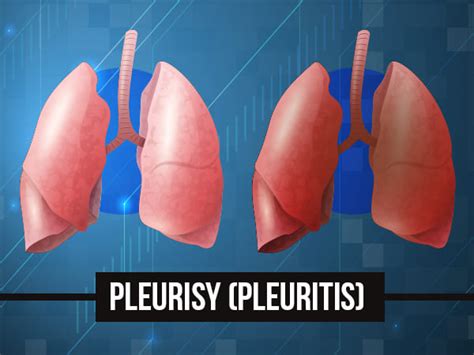 Pleurisy (Inflammation Of The Lung Lining): Symptoms, Causes, Treatments and Prevention ...