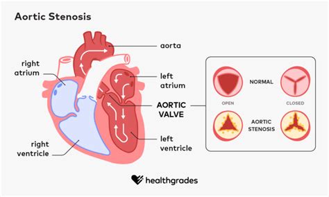 Aortic Stenosis - Progression, Outlook, Symptoms, and Treatments